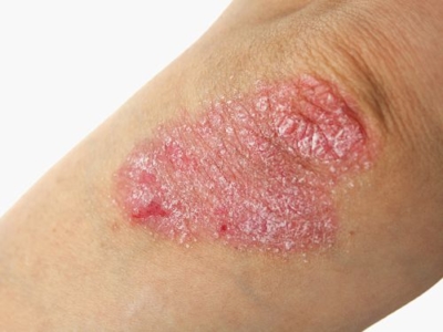 Psoriasis